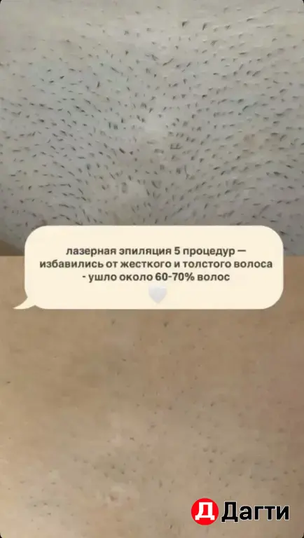 мастер лазерной эпиляции