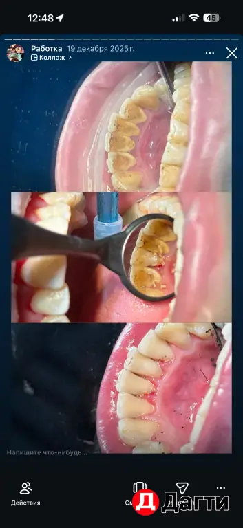 Профессиональное отбеливание Зубов