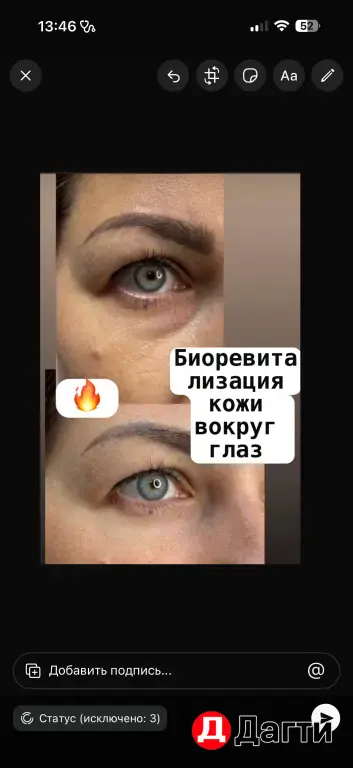 Биоревитализация