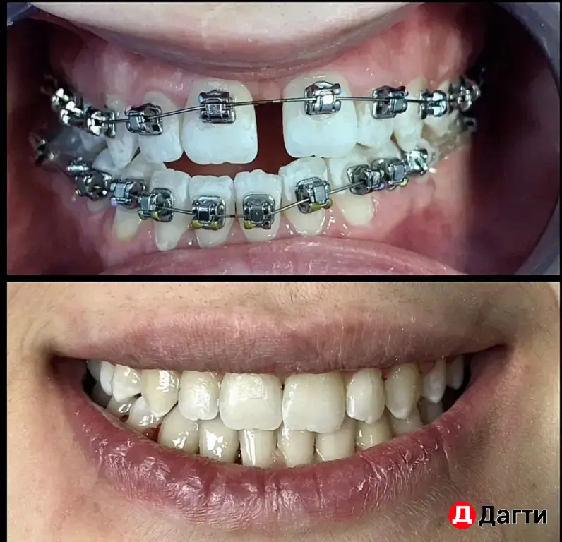 брекеты,элайнеры,аппараты Махачкала